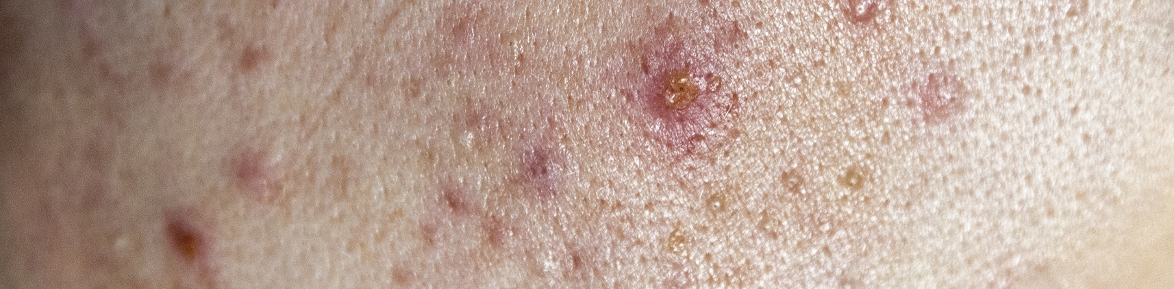 Lesioni cutanee che possono essere associate all’idrosadenite suppurativa